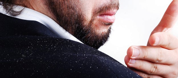 Dandruff - What to Do?